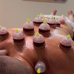 Stručnjak izvodi hidžama tretman, koristeći specijalizovane čaše za ublažavanje bolova i napetosti kod klijenta.